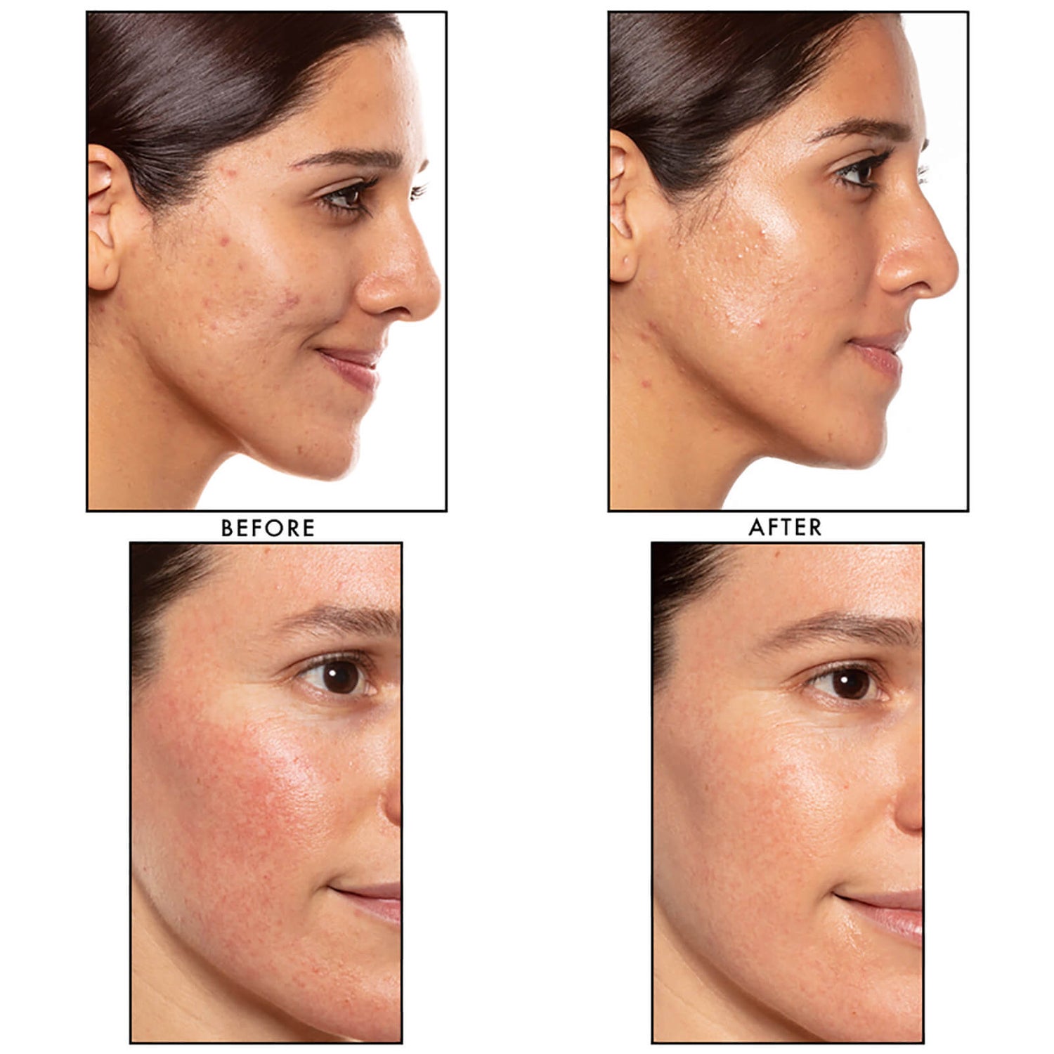 Retinol Serum With Botanical Hyaluronic Acid For Wrinkles And Dark