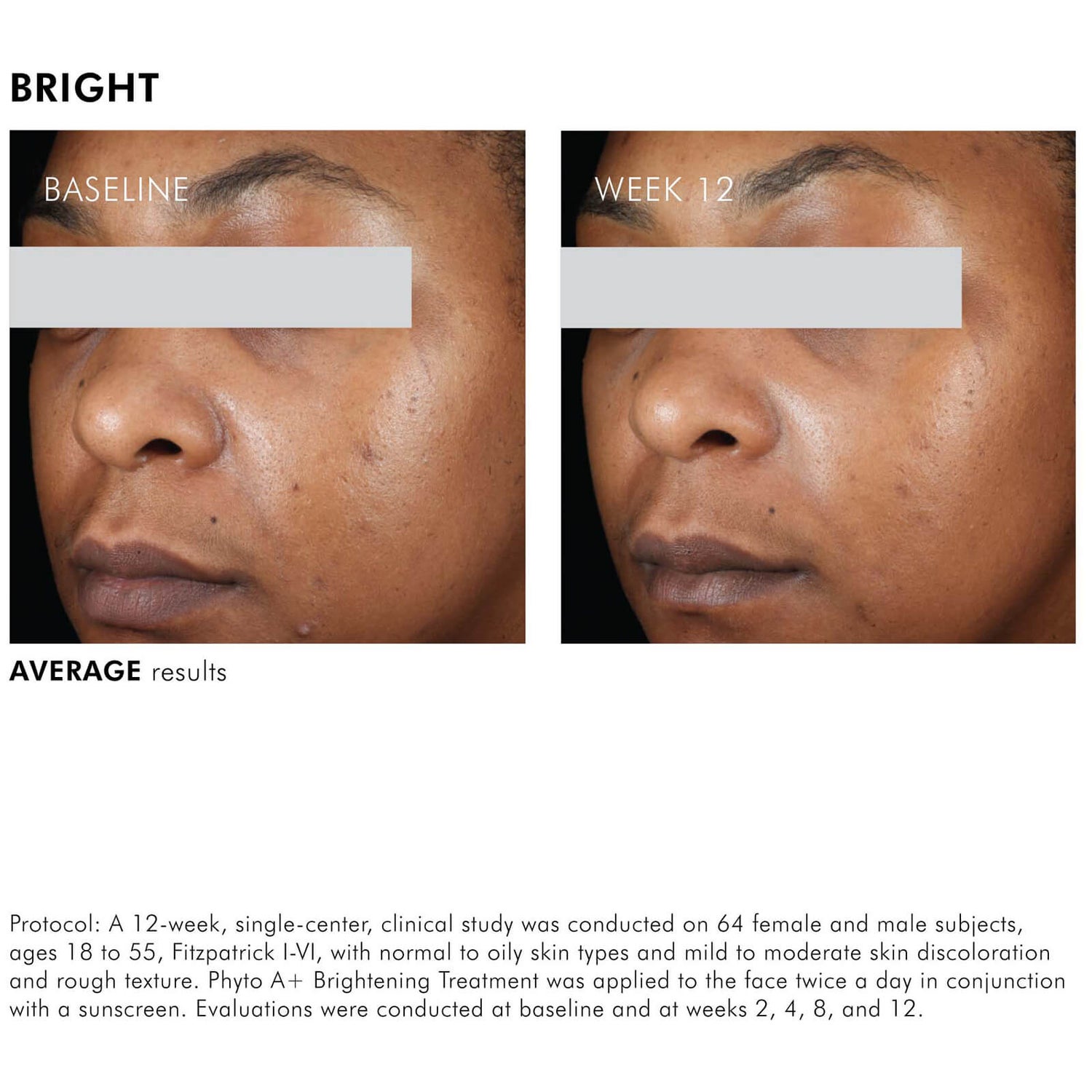 Post Inflammatory Hyperpigmentation Treatment Cream Buy Stores www