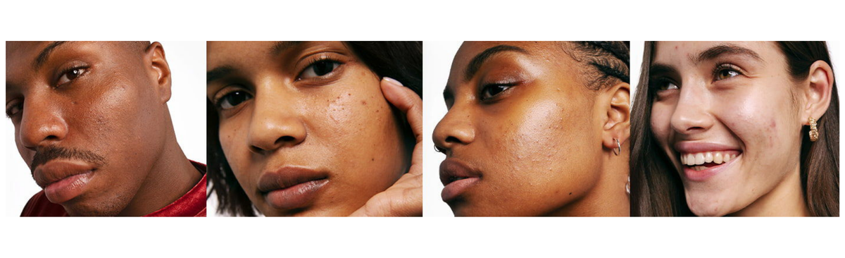 The perfect skin care routine for acne