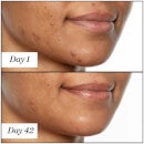 Sunday Riley U.F.O. Ultra-Clarifying Acne Treatment Face Oil (1.18 fl. oz.)