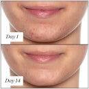 Sunday Riley U.F.O. Ultra-Clarifying Acne Treatment Face Oil (1.18 fl. oz.)
