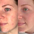Caudalie 4 Steps for 4 Weeks Acne Prone Skin Programme 