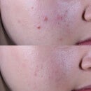Acne Relief Maximum Strength Clearing Treatment
