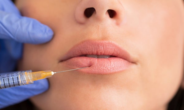 What Are Lip Fillers, and Are They Worth It?