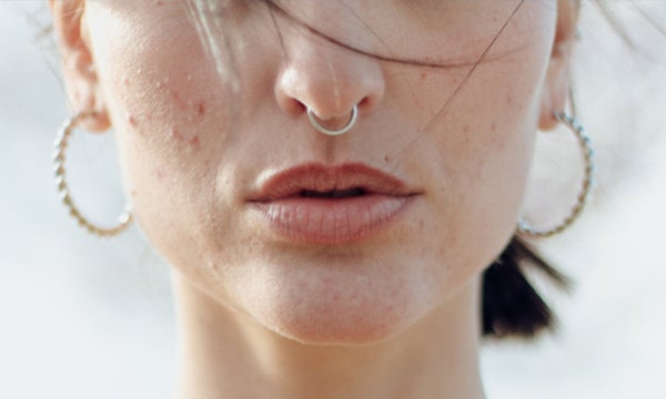 How I Finally Cleared Up My Adult Acne, With a Dermatologist’s Help