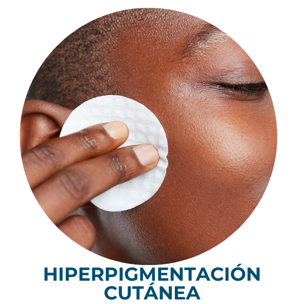 TEINT INÉGAL hyperpigmentation