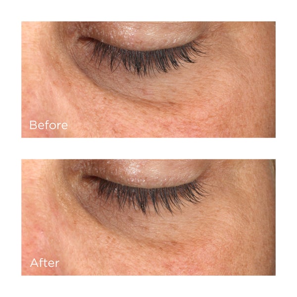 Cold Plasma Plus+ Advanced Eye Cream Before and After Images