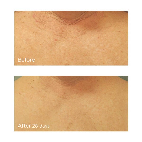 Neuropeptide Restorative Neck and Chest Before and After Images