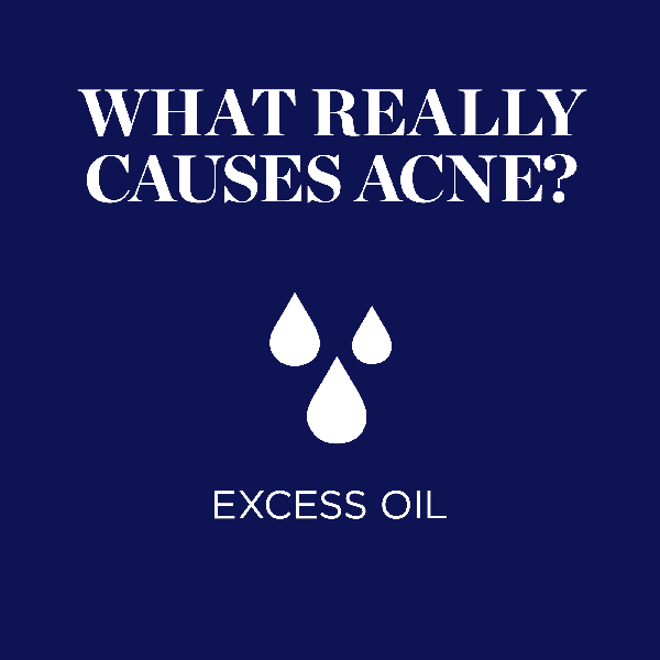 What really causes acne? inflammation, acne causing bacteria, inflammation, excess oil.