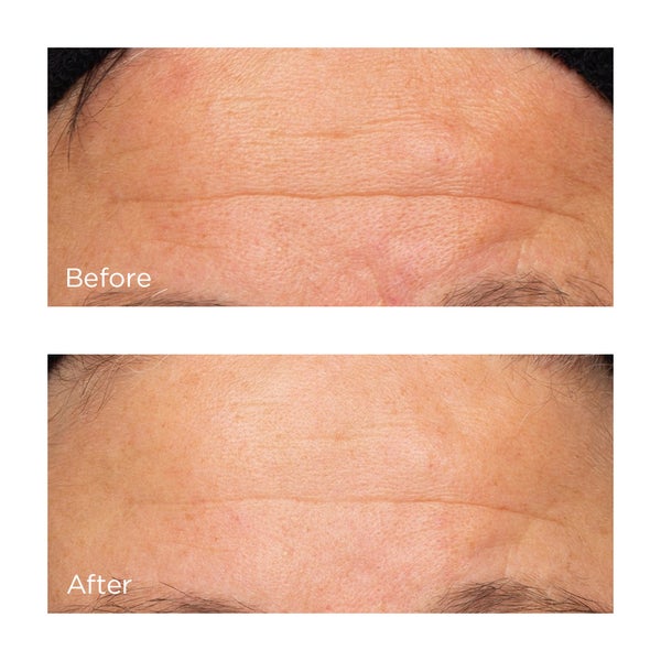 Cold Plasma Plus+ The Intensive Hydrating Complex Before and After Images