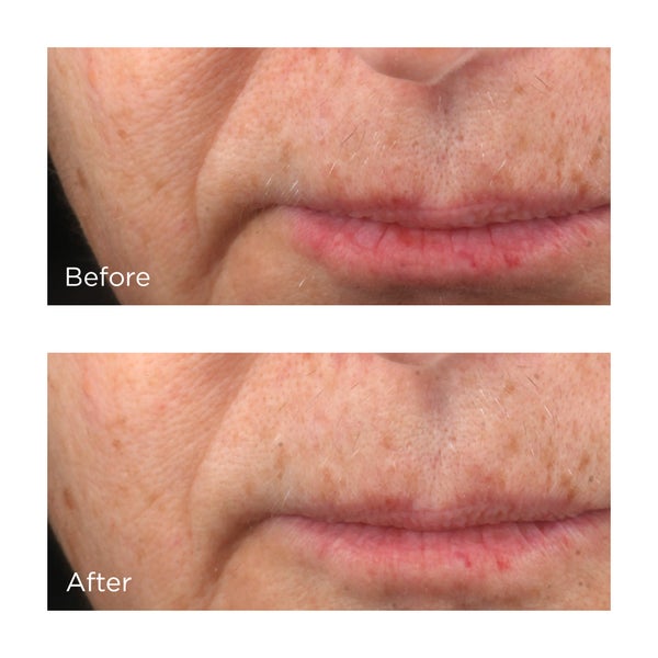 Cold Plasma Plus+ Advanced Serum Concentrate Before and After Images