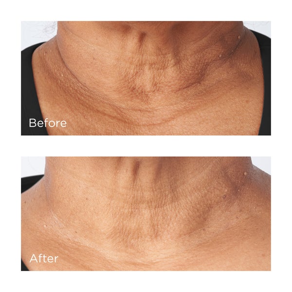 Cold Plasma Plus+ Sub-D/Neck Before and After Images
