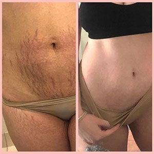 Before and After image of stretch marks on tummy faded. Shop All products.