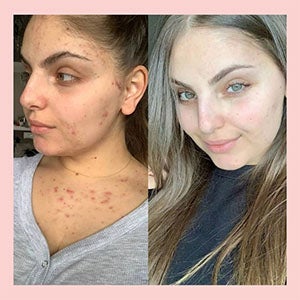 Before image of red spots on a woman's face and chest and After image of faded red spots on woman's face and chest. Shop All products
