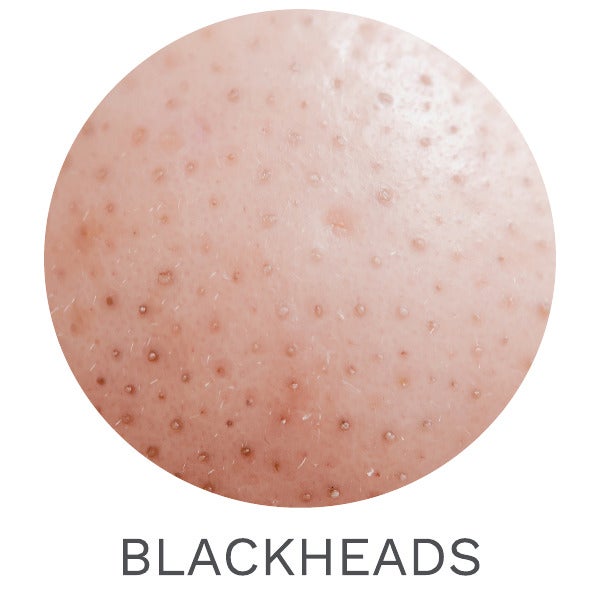 BLACKHEADS