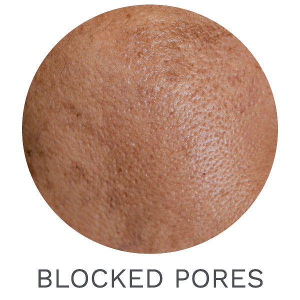 BLOCKED PORES