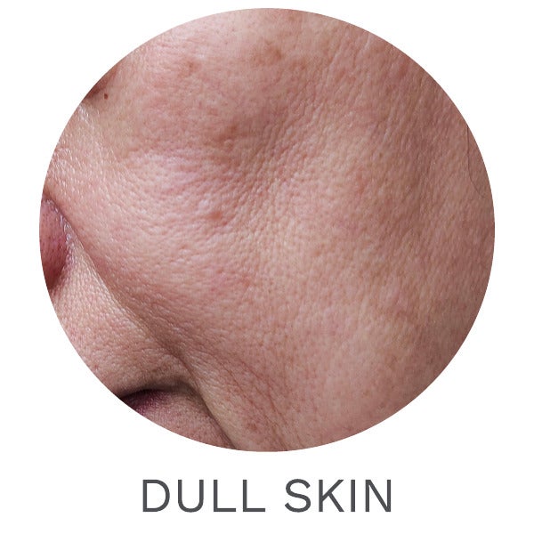 DULL SKIN