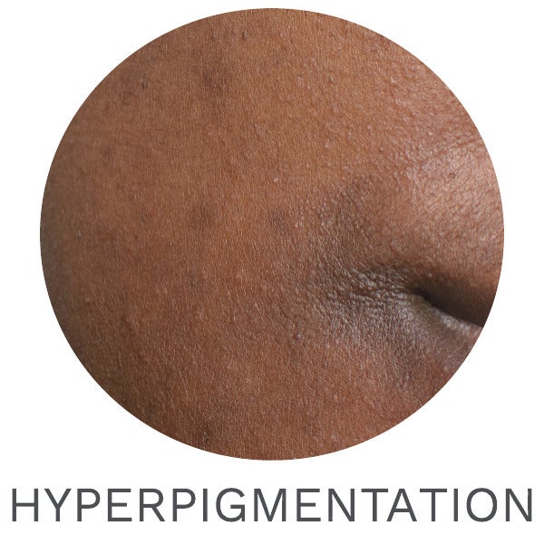 HYPERPIGMENTATION