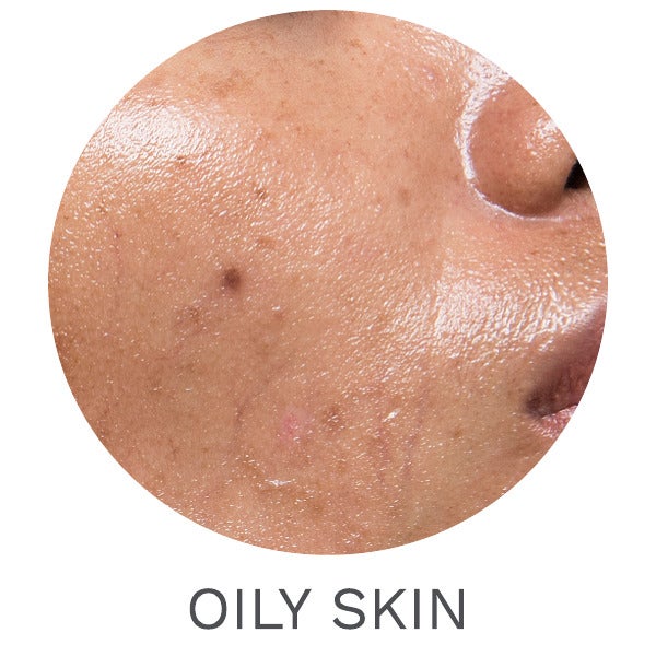 Dermatological Skincare for Oily Skin