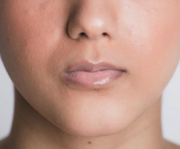 The Best Treatments for Lip Lines and Lip Wrinkles