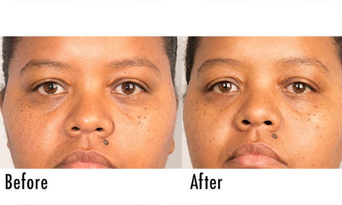 Fillerina Review: Before and After Pictures 4 | Dermstore Blog