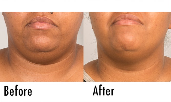 Fillerina Review: Before and After Pictures 3 | Dermstore Blog
