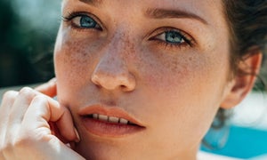 Melasma 101: Everything You Need to Know About This Common Skin Condition