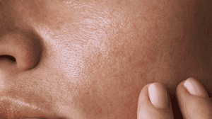 Six ways to control oily skin