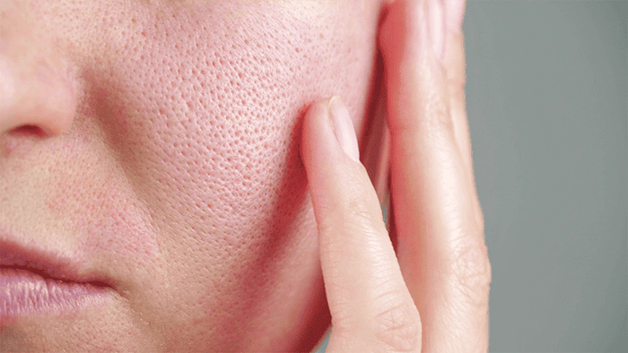 close-up of woman with large pores