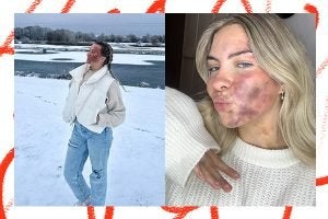 two images of nancy morel. one of her wearing jeans and a white gillet in a snowy landscape, the other is a selfie of her doing a kiss pose with her skin flared up