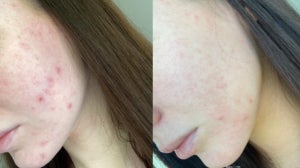 We used blue light therapy for a month and here are the results