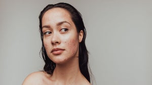 How to Manage Adult Acne