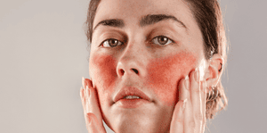 Rosacea Relief: The Best Skincare Solutions