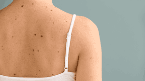 What Are Freckles And Moles? Friend Or Foe