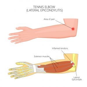 Tennis- & Golferarm | Übungen & Behandlung