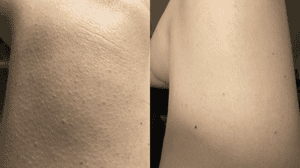 How I Cured Keratosis Pilaris On My Legs | Testimonial