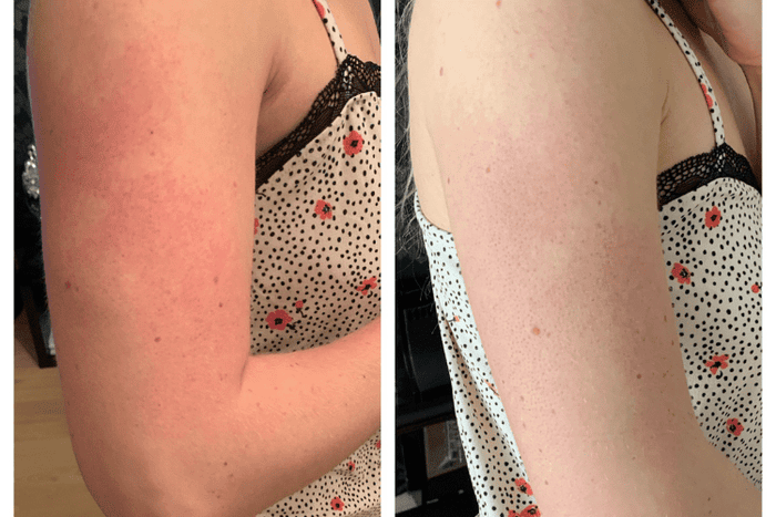 Red bumps on arms before and after 