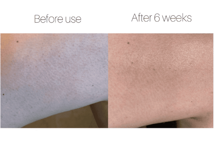 before and after of bumpy skin on back of arms