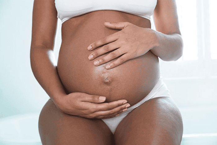 Are Stretch Marks Genetic?, Your No.1 Question Answered