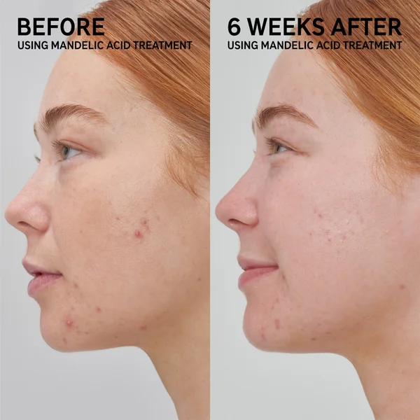 The INKEY List Mandelic Acid Treatment 15ml_5