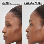 The INKEY List Mandelic Acid Treatment 15ml_6