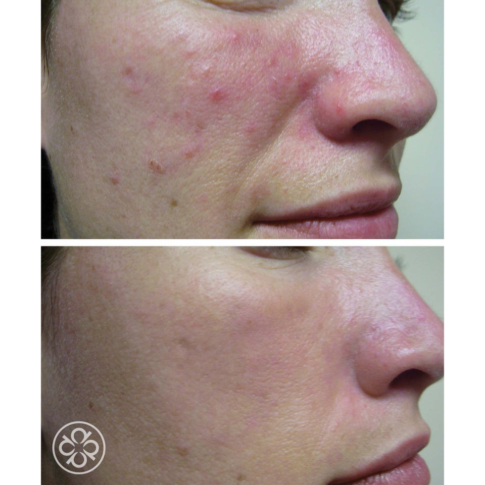 SpaTeen Blemished Skin Moisturizer