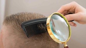 Dealing With Dandruff