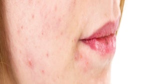 Acne Scars: Heal Your Skin Safely And Effectively