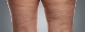 Wie man Cellulite „los wird“ | Wissenschaftlicher Fakt oder Fiktion