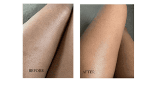 How I Treated The Ingrown Hairs On My Legs | Testimonial