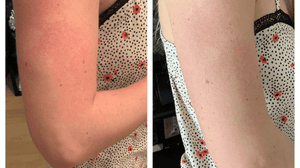 Treating The Red Bumps On My Upper Arms | Testimonial