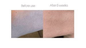 Treating The Bumps On The Back Of My Arms | Testimonial