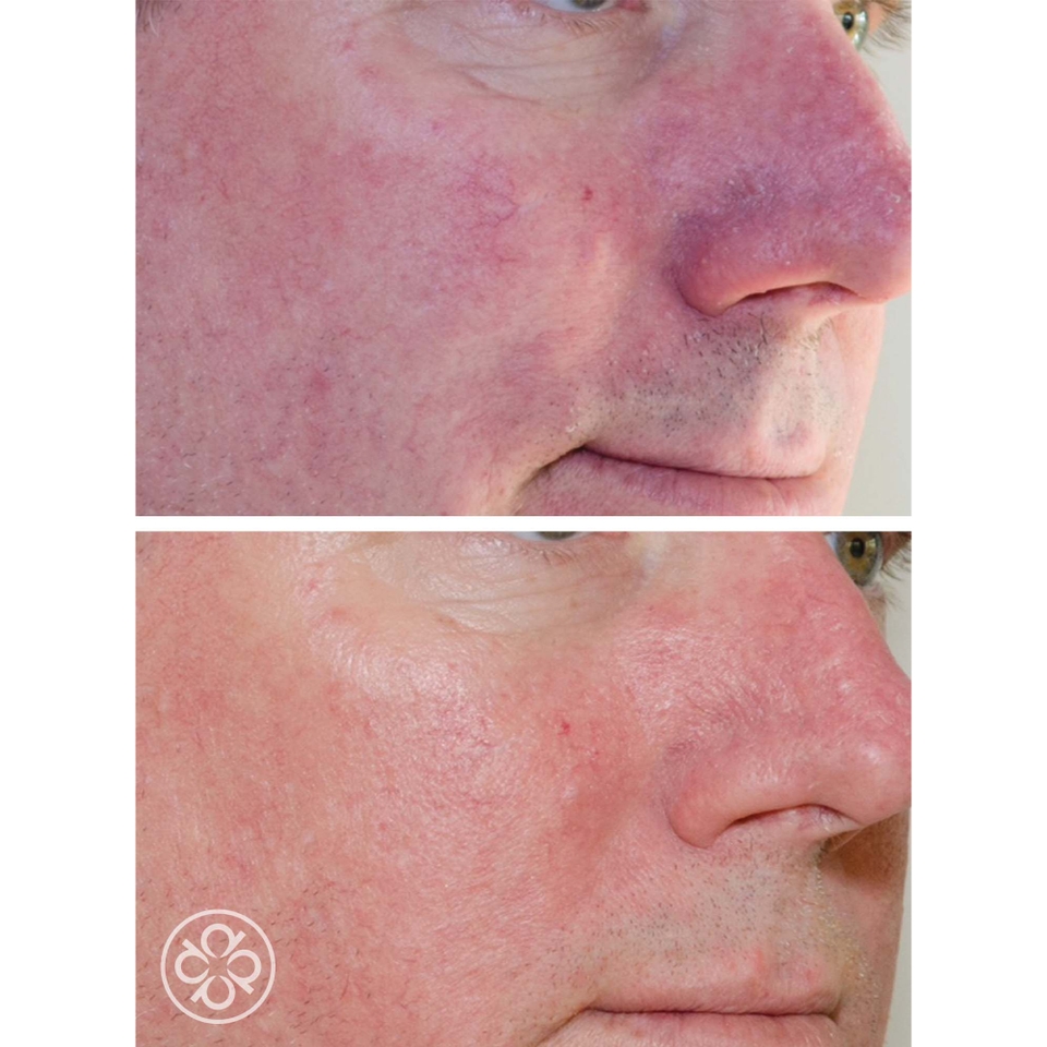 Redness-B-Gone Trial Kit - Redness Skincare Solution (RS2)