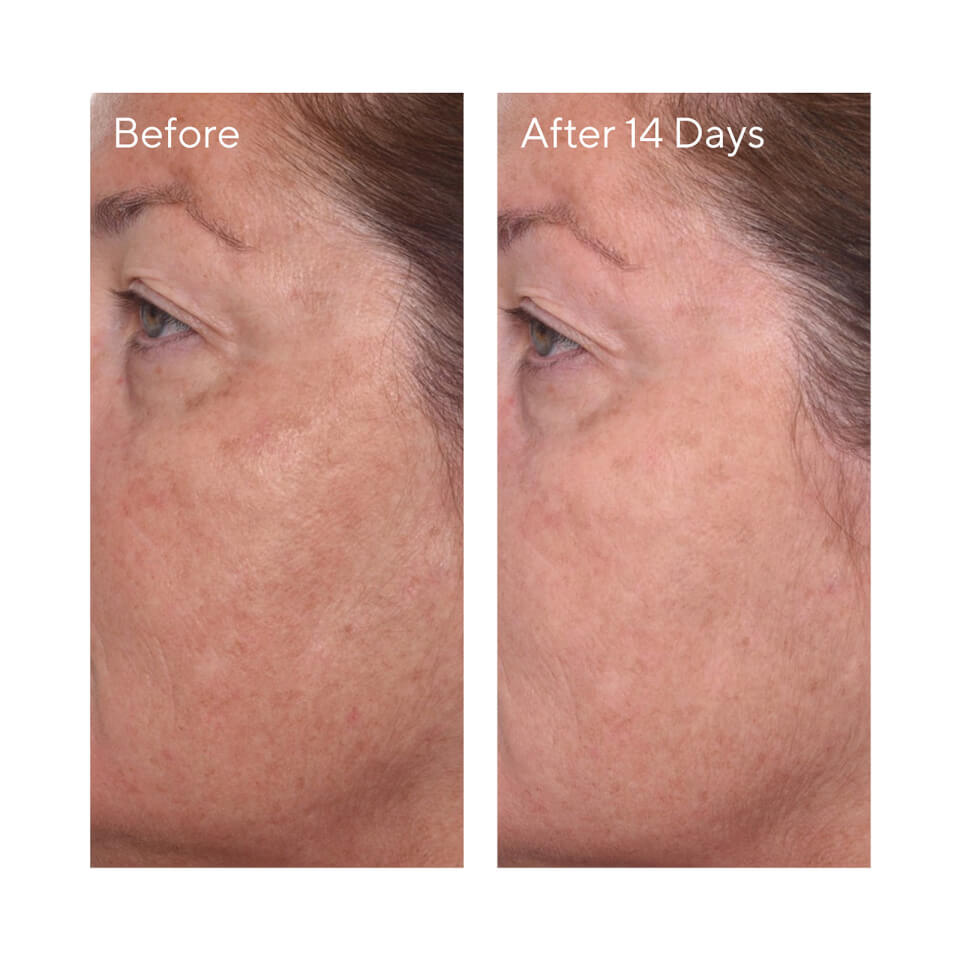 Murad rapid age 2025 spot correcting serum
